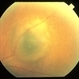 Subretinal Tumor
